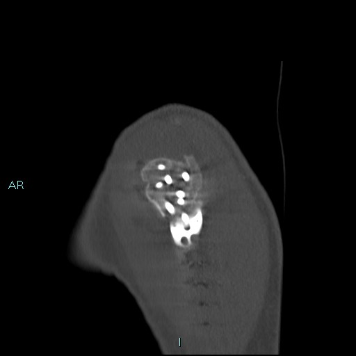 Avascular necrosis after fracture dislocations of the proximal humerus (Radiopaedia 88078-104653 Sagittal bone window 15).jpg