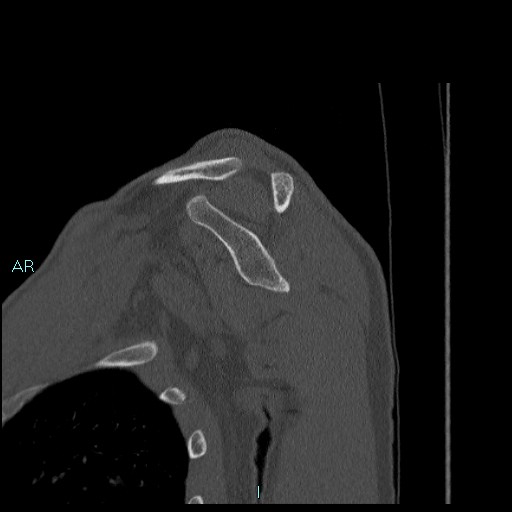 Avascular necrosis after fracture dislocations of the proximal humerus (Radiopaedia 88078-104655 Sagittal bone window 36).jpg