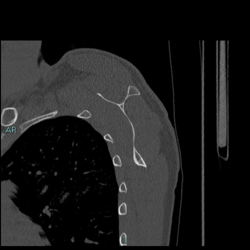 Avascular necrosis after fracture dislocations of the proximal humerus (Radiopaedia 88078-104655 Sagittal bone window 57).jpg