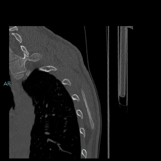 File:Avascular necrosis after fracture dislocations of the proximal humerus (Radiopaedia 88078-104655 Sagittal bone window 91).jpg