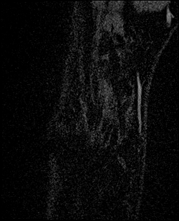 Avascular necrosis of the capitate (Radiopaedia 88317-104948 Coronal T1 vibe 6).jpg