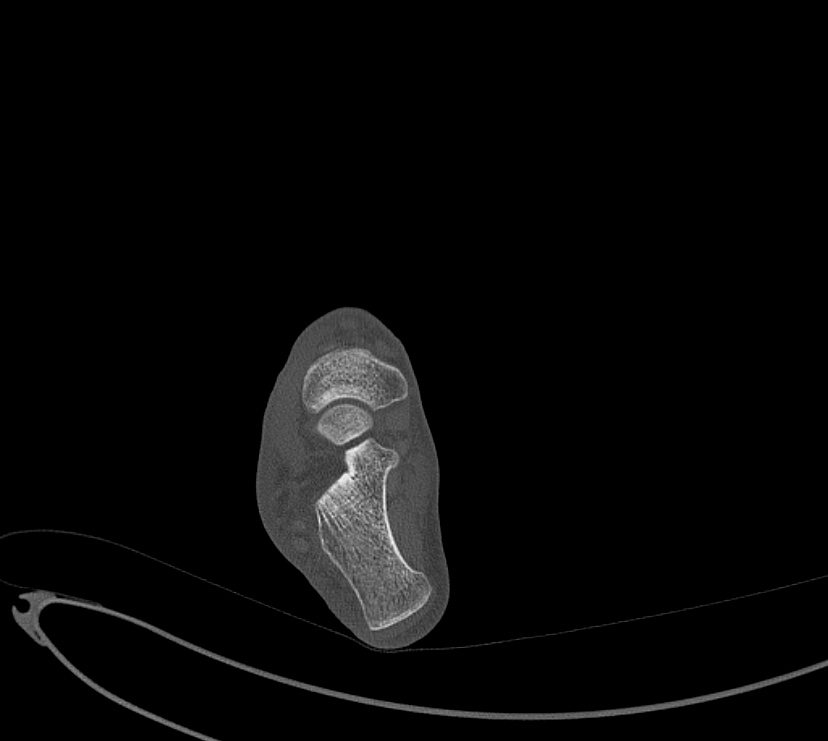 Avulsion fractures of talus and calcaneus (Radiopaedia 48277-53155 Axial bone window 57).jpg