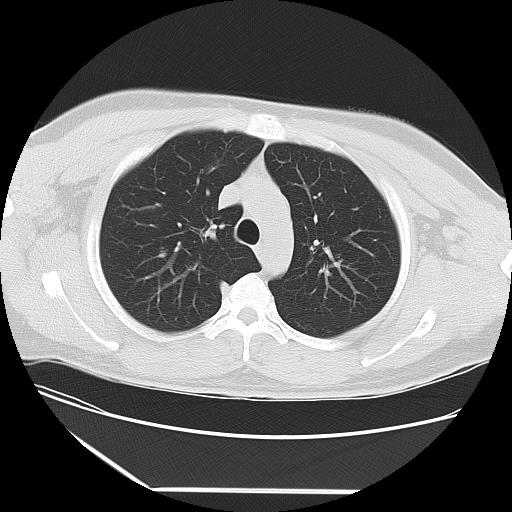 Azygos fissure (Radiopaedia 88181-104784 Axial lung window 14).jpg