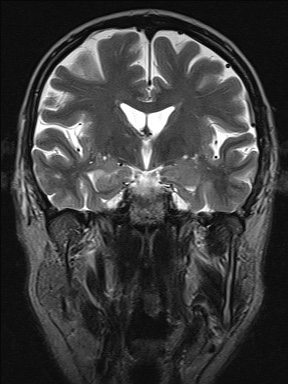 Balo concentric sclerosis (Radiopaedia 50458-55940 Coronal T2 25).jpg