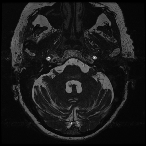 File:Balo concentric sclerosis (Radiopaedia 53875-59982 Axial T2 FIESTA 24).jpg