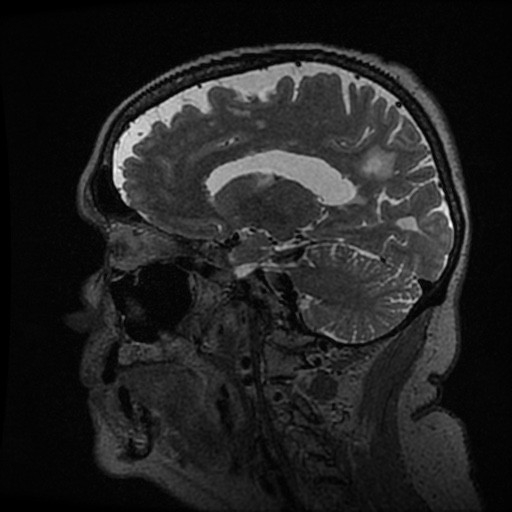 Balo concentric sclerosis (Radiopaedia 53875-59982 Sagittal 3D FSE 112).jpg