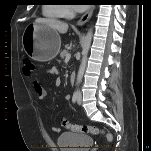 File:Bariatric balloon causing gastric outlet obstruction (Radiopaedia 54449-60672 C 42).jpg