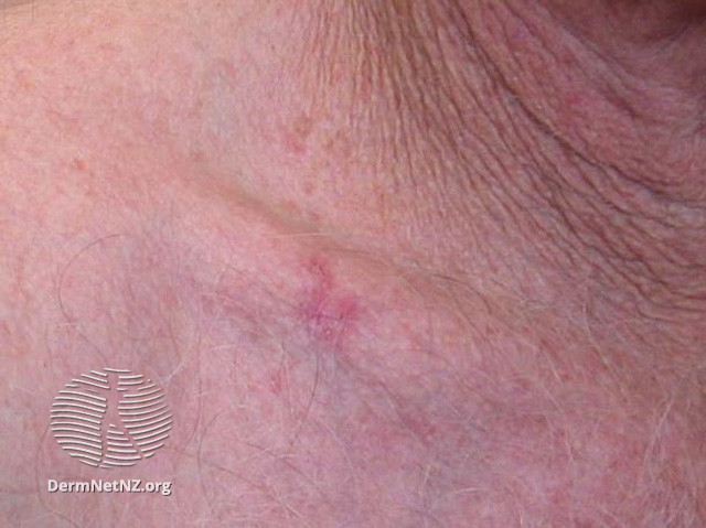 File:Basal cell carcinoma affecting the trunk (DermNet NZ lesions-bcc-trunk-1169).jpg