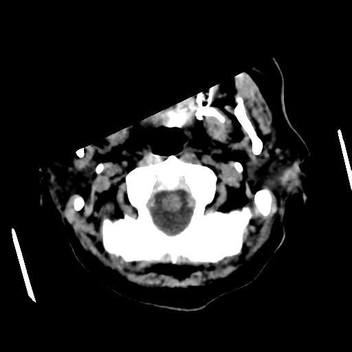 Basal ganglia metastasis (Radiopaedia 78928-91830 Axial non-contrast 10).png
