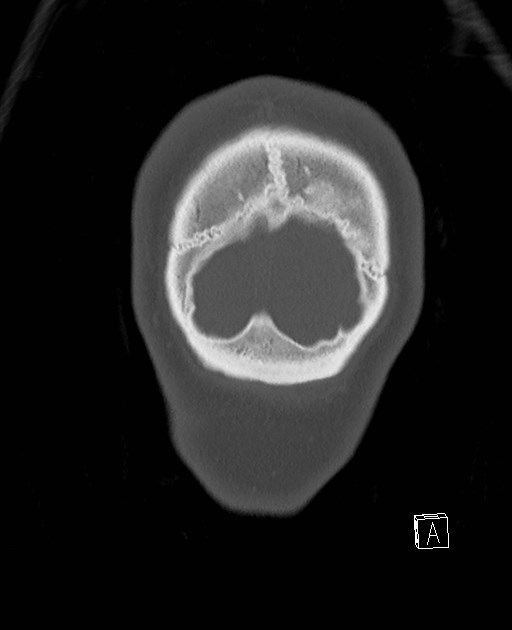 Base of skull fracture with bilateral Le Fort fractures (Radiopaedia 47094-51638 Coronal bone window 4).jpg