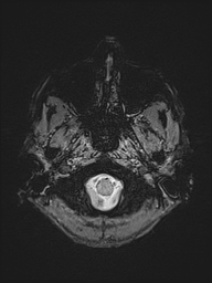 File:Basilar artery perforator aneurysm (Radiopaedia 82455-97733 Axial SWI 1).jpg