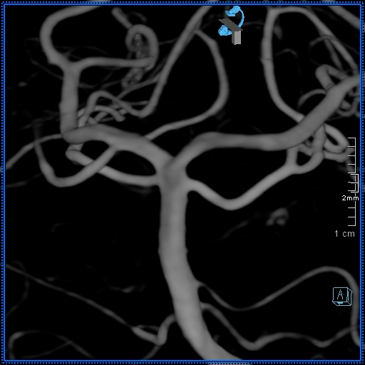 File:Basilar artery perforator aneurysm (Radiopaedia 82455-99524 3D Left VA 39).jpg