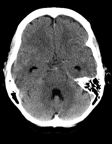 File:Basilar tip aneurysm with coiling (Radiopaedia 53912-60033 Axial 13).jpg