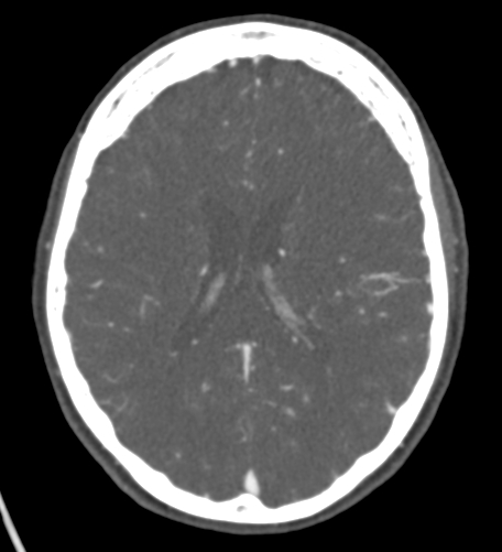 Basilar tip aneurysm with coiling (Radiopaedia 53912-60086 A 91).jpg
