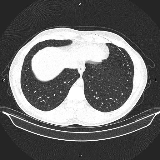 Beam hardening and ring artifacts (Radiopaedia 85323-100915 Axial lung window 61).jpg