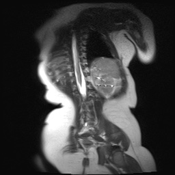 File:Beckwith-Wiedeman syndrome with bilateral Wilms tumors (Radiopaedia 60850-69233 B 3).jpg