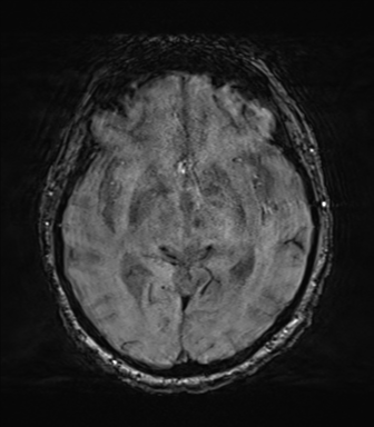 File:Behavioral variant frontotemporal dementia and late onset schizophrenia (Radiopaedia 52197-58083 Axial SWI 33).png