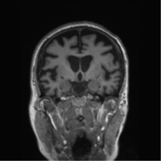 Behavioral variant frontotemporal dementia and late onset schizophrenia (Radiopaedia 52197-58083 Coronal T1 54).png