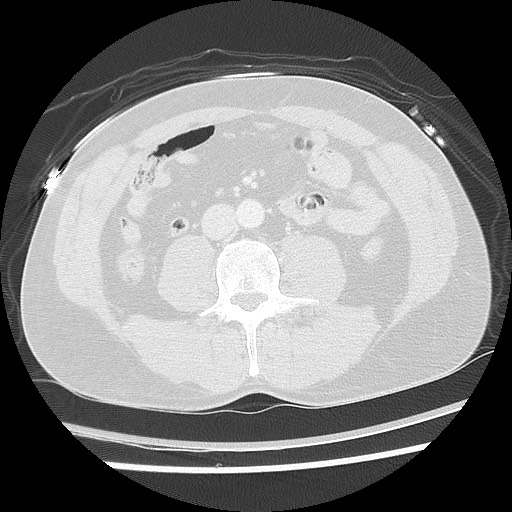 Benign post-traumatic pseudopneumoperitoneum (Radiopaedia 71199-81495 Axial lung window 96).jpg
