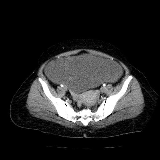 Benign spindle cell tumor - abdominopelvic (Radiopaedia 61300-69212 A 49).jpg