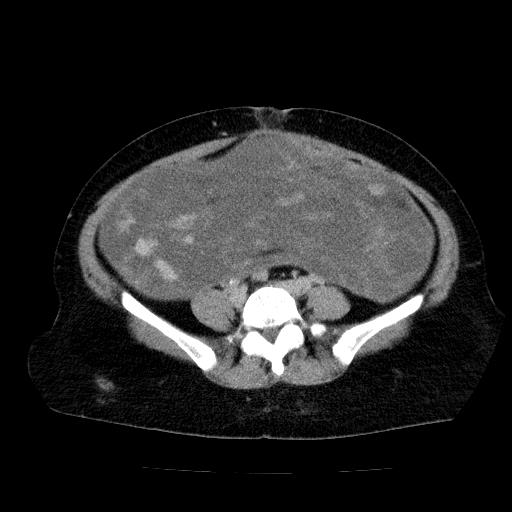 File:Benign spindle cell tumor - abdominopelvic (Radiopaedia 61300-69212 Axial C+ delayed 42).jpg