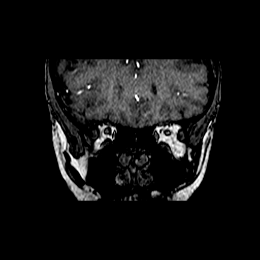 Berry aneurysm of the terminal internal carotid artery (Radiopaedia 88286-104918 Coronal TOF 12).jpg