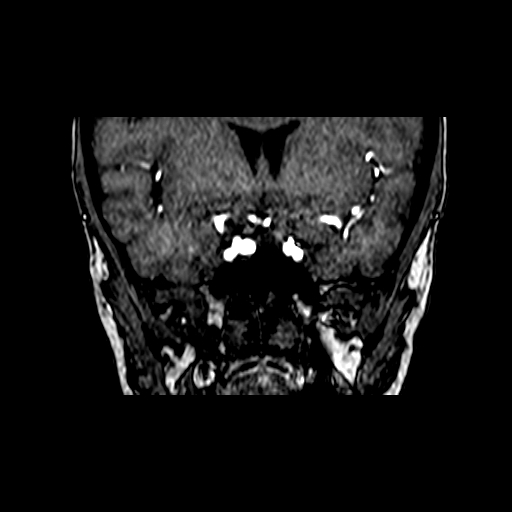 Berry aneurysm of the terminal internal carotid artery (Radiopaedia 88286-104918 Coronal TOF 33).jpg