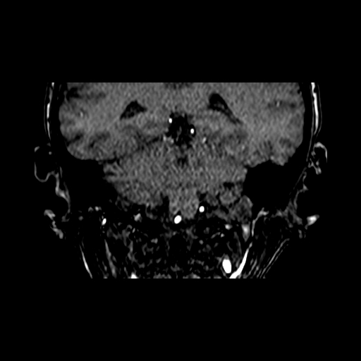 Berry aneurysm of the terminal internal carotid artery (Radiopaedia 88286-104918 Coronal TOF 73).jpg