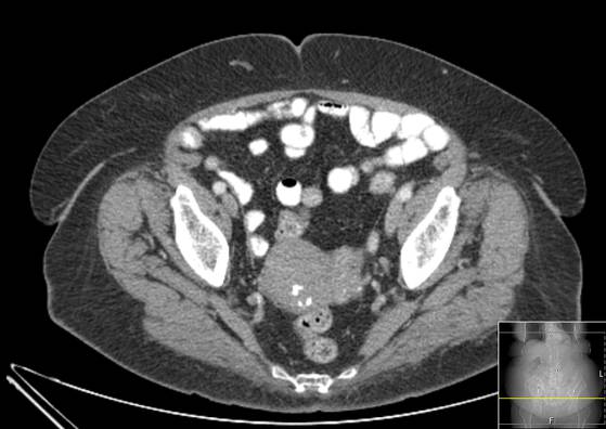 Bicameral celiacomesenteric aneurysm (Radiopaedia 55766-62327 A 60).jpg