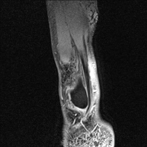 Bilateral Achilles tendon complete tear (Radiopaedia 81344-95051 Sagittal WE - Right 17).jpg