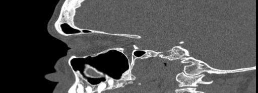 Bilateral Ectopic Infraorbital Nerves (Radiopaedia 49006-54084 Sagittal bone window 34).jpg