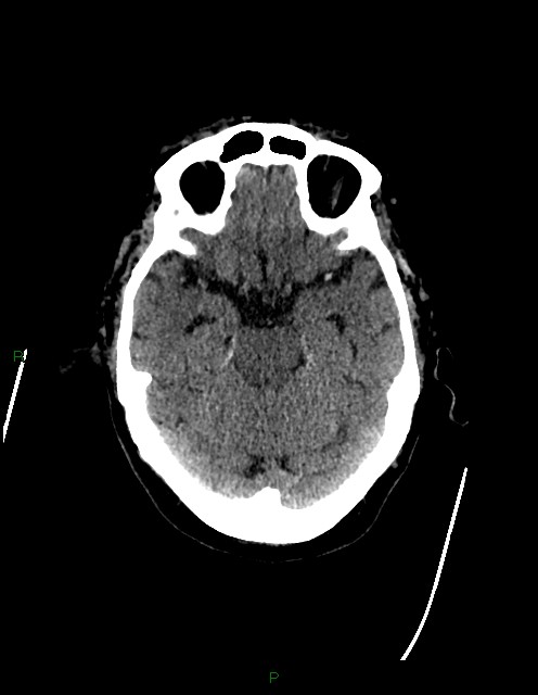 Bilateral acute middle cerebral artery territory infarcts (Radiopaedia 77319-89401 Axial non-contrast 30).jpg