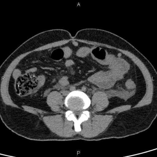 Bilateral adrenal gland hyperenhancement in pancreatitis (Radiopaedia 86642-102753 Axial non-contrast 73).jpg