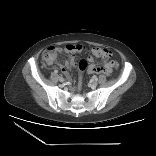 Bilateral adrenal granulocytic sarcomas (chloromas) (Radiopaedia 78375-91007 A 87).jpg