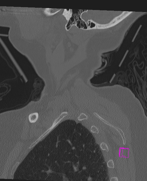 Bilateral atlanto-occipital assimilation (Radiopaedia 28350-28603 Sagittal bone window 6).jpg