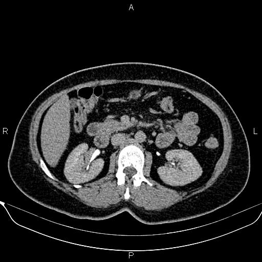 Bilateral benign adrenal adenomas (Radiopaedia 86912-103124 Axial C+ delayed 59).jpg