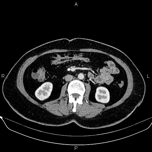 Bilateral benign adrenal adenomas (Radiopaedia 86912-103124 B 55).jpg