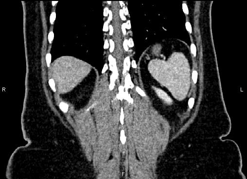 Bilateral benign adrenal adenomas (Radiopaedia 86912-103124 D 55).jpg