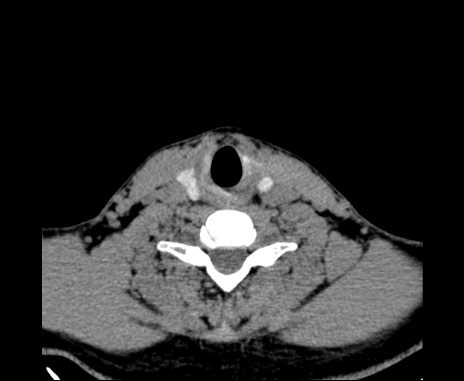 Bilateral carotid body tumors (Radiopaedia 61841-69870 Axial non-contrast 83).jpg