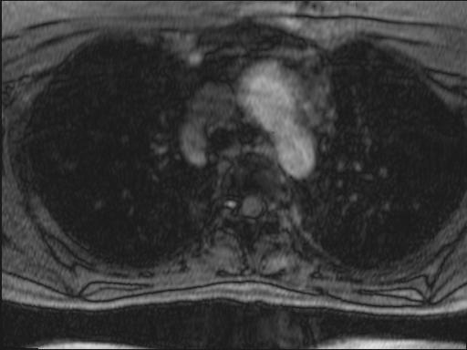 Bilateral carotid body tumors and right glomus jugulare tumor (Radiopaedia 20024-20060 Axial MRA 146).jpg