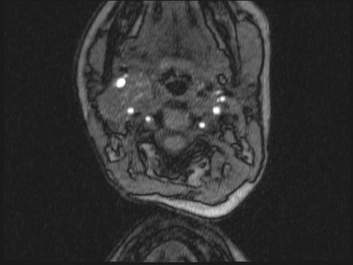 Bilateral carotid body tumors and right glomus jugulare tumor (Radiopaedia 20024-20060 Axial MRA 266).jpg
