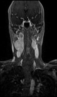 Bilateral carotid body tumors and right glomus jugulare tumor (Radiopaedia 20024-20060 MRA 29).jpg