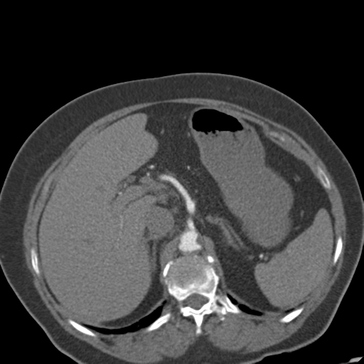 File:Bilateral delayed nephrogram from renal artery stenosis (Radiopaedia 47681-52362 A 16).png