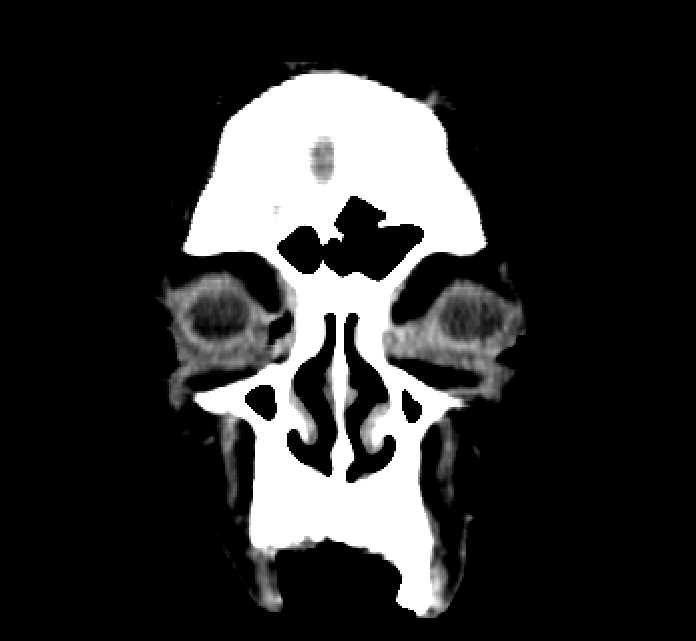 Bilateral ectopia lentis (Radiopaedia 89889-107013 Coronal non-contrast 13).jpg