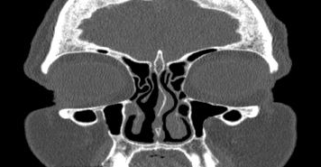 File:Bilateral ectopic infraorbital nerves (Radiopaedia 49006-54084 Coronal 55).png