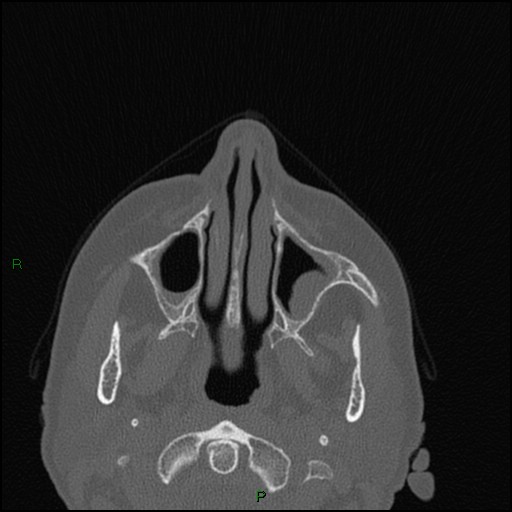 File:Bilateral frontal mucoceles (Radiopaedia 82352-96454 Axial bone window 216).jpg