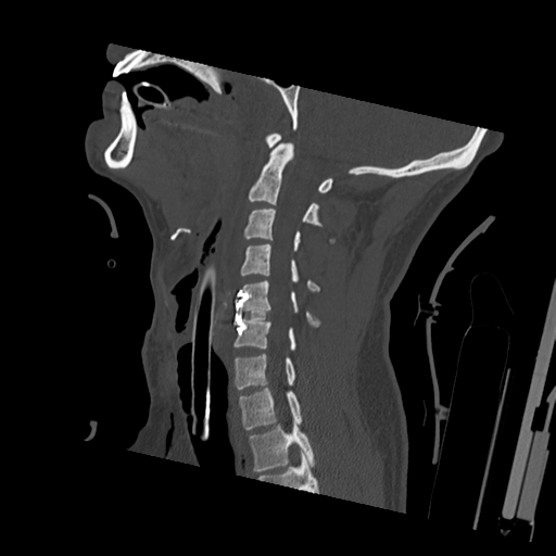 Bilateral locked facets (Radiopaedia 33850-35023 Sagittal bone window 34).png