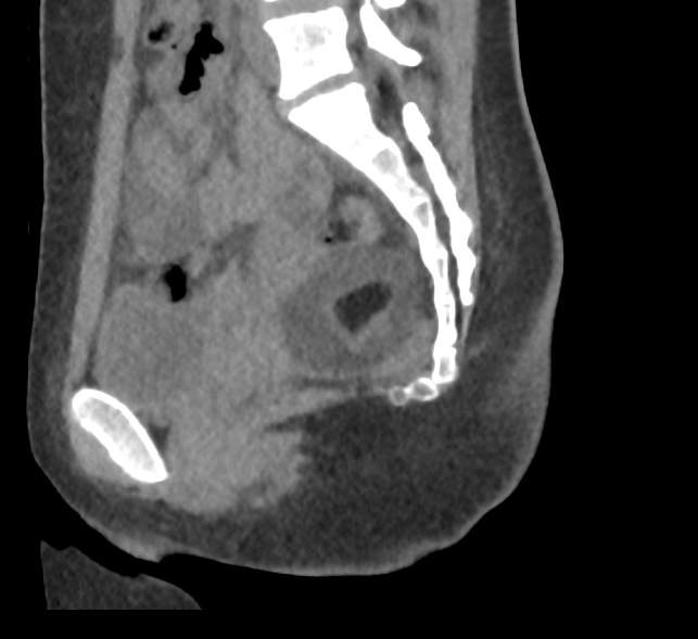 Bilateral mature cystic ovarian teratoma (Radiopaedia 88821-105592 D 37).jpg