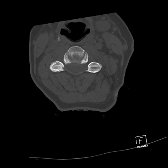 Bilateral occipital condyle fractures (type 3) (Radiopaedia 87672-104086 Axial bone window 37).jpg
