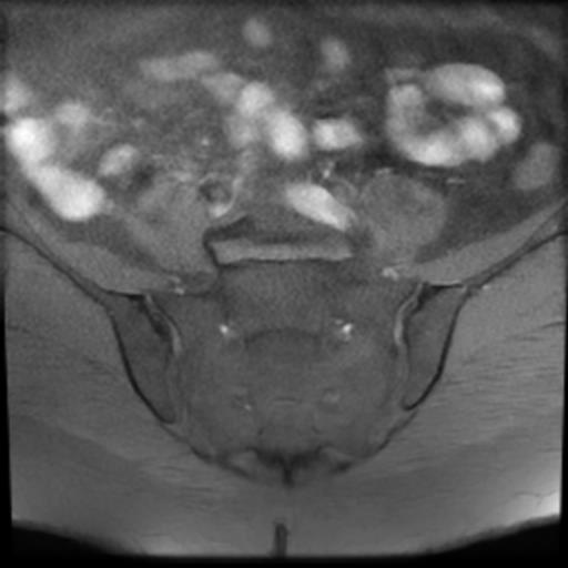 File:Bilateral ovarian dermoid cysts (Radiopaedia 90152-107338 Axial T1 fat sat 3).jpg